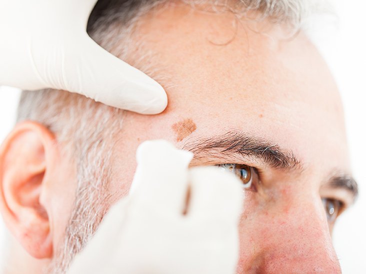 Chryotherapy used to Removed an Aged Spot